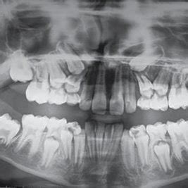 Orthopantomograph Showing Impacted Right And Left Permanent Maxillary