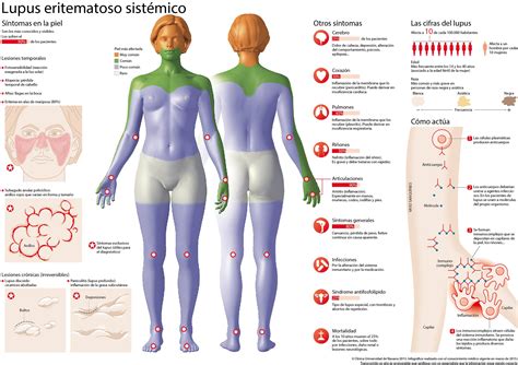 Lupus Eritematoso Sist Mico S Ntomas Diagn Stico Y Tratamiento Cun