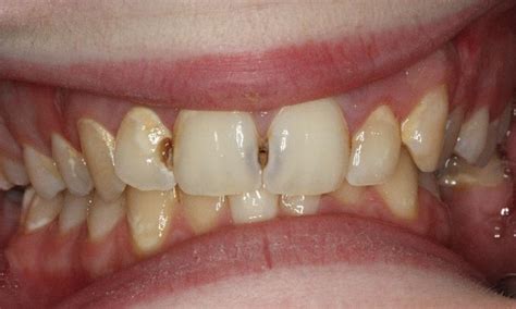 Dental Filling Front Teeth