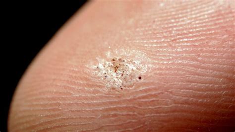 What Are Seed Warts Causes Prevention And Treatment