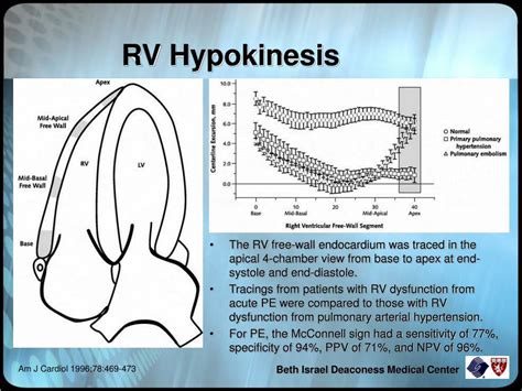 Ppt Echocardiography In Pulmonary Embolism Powerpoint Presentation Free Download Id 7023070