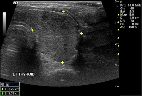 Thyroid Ultrasound Top 10 Pathology 9 Graves Disease