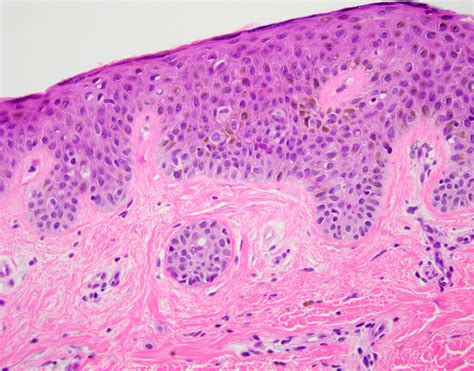 Compound Nevus With Mild Atypia