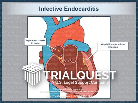 Bacterial Endocarditis Vegetation