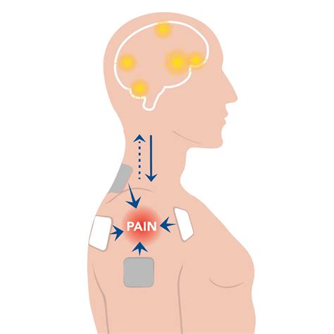 Tens Unit Buyers Guide How To Choose A Tens Machine Carex