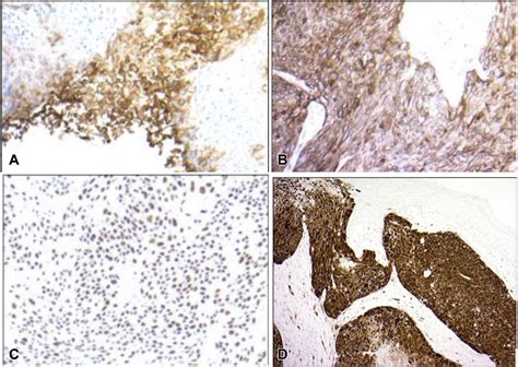 A Rare Case Of Anal Squamous Cell Carcinoma Metastasizing To The Scrotum Jaad Case Reports