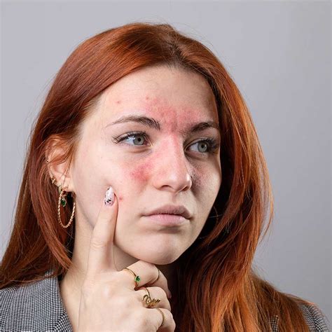 Effective Treatment Of Rosacea And Couperosis Dr Bernier