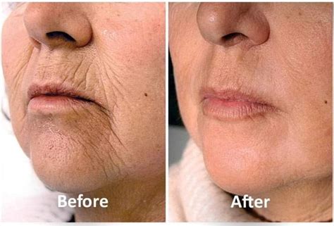 OxyGeneo TriPollar Face Neck Tightening Ottawa Medispa Orleans