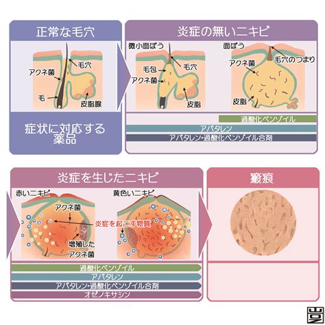 ニキビとは、原因、症状、治療など 新宿駅前クリニック皮膚科