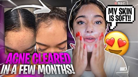 How I Fully Cleared My Acne My Every Day Skin Care Routine Youtube