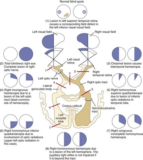 Left Temporal Visual Field