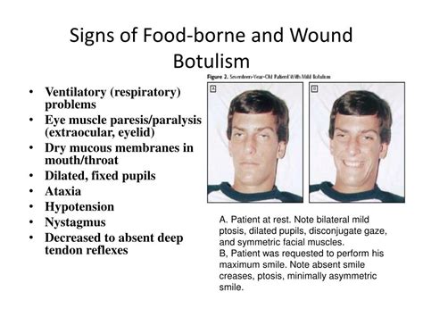 Botulism Symptoms : Botulism: Symptoms, Causes, Prevention, and Types ...