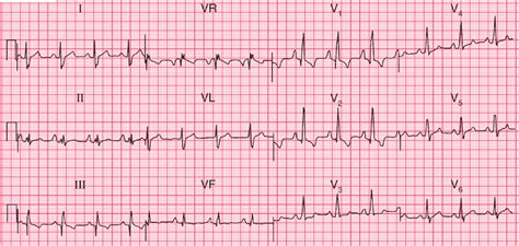 ECG Case 115: Right Atrial and Right Ventricular Hypertrophy - Manual ...