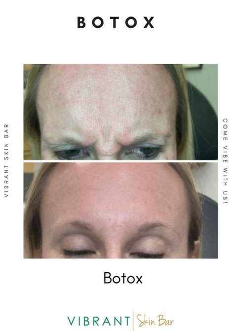 Best Botox Phoenix Vibrant Skin Bar