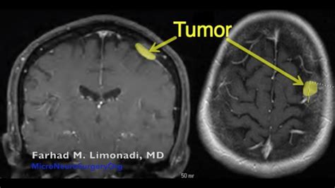 Brain Surgery Surgical Removal Of Right Frontal Meningioma Youtube