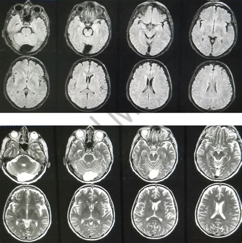 Computer Tomography Images Showing Retro Cerebellar Arachnoid Cyst