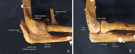 The Lateral Collateral Ligament Complex Of The Elbow Quantitative