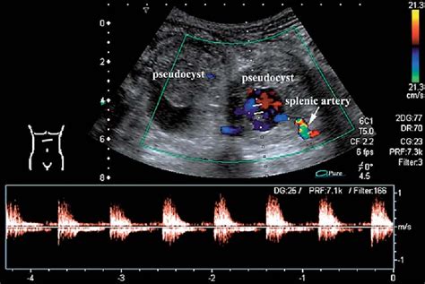 Splenic Artery Ultrasound