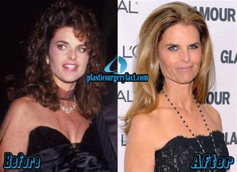 Maria Shriver Plastic Surgery Before and After Photos