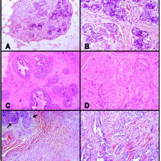 Case 84 Classic Lobular Carcinoma In Situ And Associated Low Grade