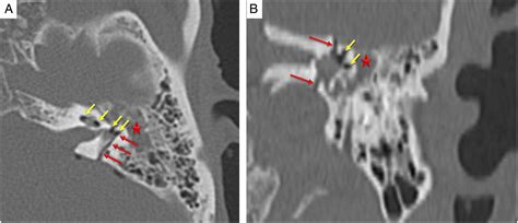 Case Report Of A Patient With Posttraumatic Perilymphatic Fistula Ali