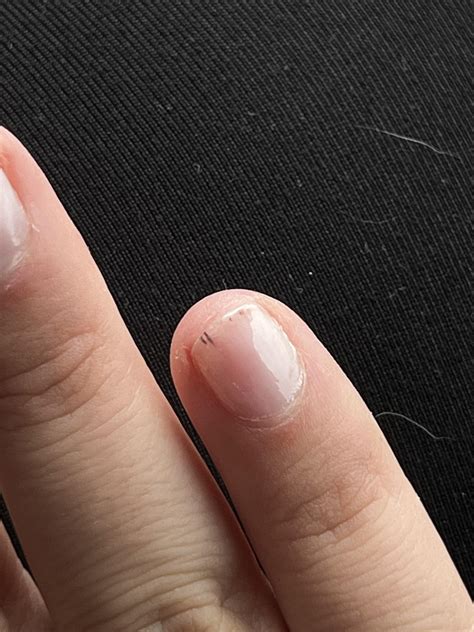 Black Lines On Nail Ive Had No Damage To My Nails Recently What