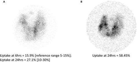 123 I Thyroid Uptake And Scan Results A Obtained Almost 3 Years