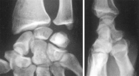 Les fractures occultes du scaphoïde carpien Détection par la