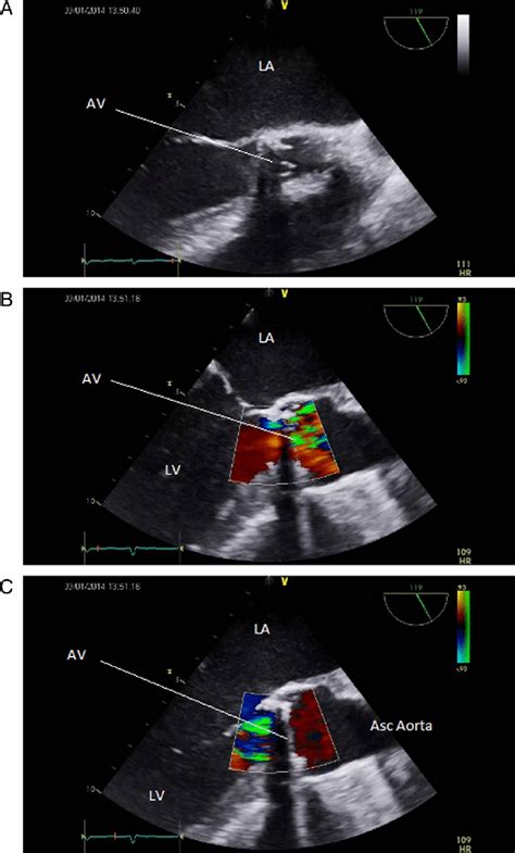 A Transesophageal Echocardiography Mid Esophageal AV LAX Showing