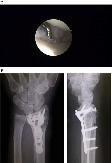 A Arthroscopic Assisted Reduction After Re Alignment Of The Distal