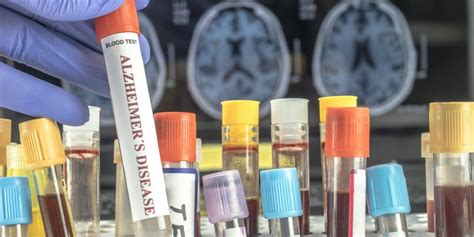 New Blood Test Shows Promise For Early Alzheimers Diagnosis Clinical