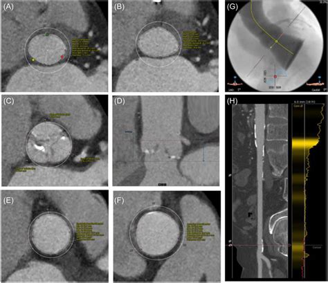 Tavr Planning Measurements Stepwise Ct Tavr Measurements Made Using