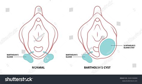 62 Afbeeldingen Voor Bartholins Glands Afbeeldingen Stockfoto‘s En