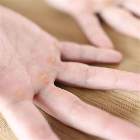 Benefits And Care Of Hand Calluses