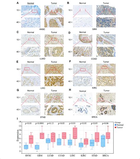 Expression Of 4ebp1 In Clinical Specimens Of Multiple Cancers Download Scientific Diagram