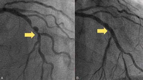 Two Step Technique Superior For Complex Coronary Bifurcations