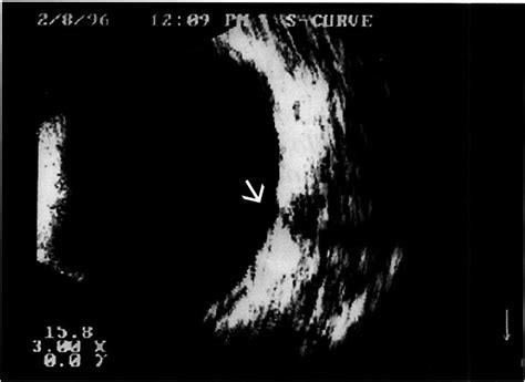 Ocular B Scan Echography Of Advanced Cupping By The Transpalpebral