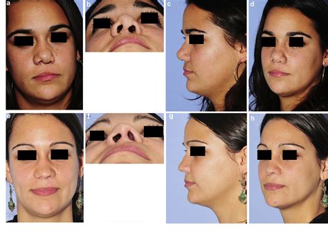 Figure 1 From Rhinoplastie De Fente Primaire Et Secondaire Semantic