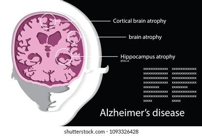 Frontal Cortices Photos, Images & Pictures | Shutterstock