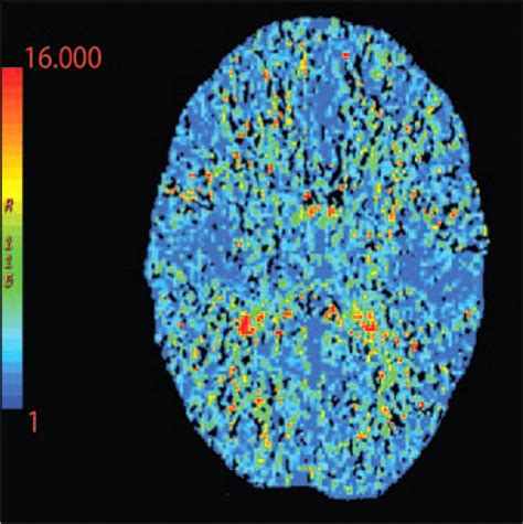 Imaging Of Stroke Part Perfusion Ct Overview Of Imaging Technique