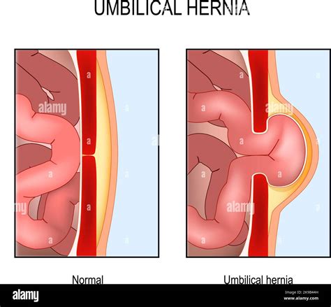 Anatomie Der Reparatur Von Leistenhernien