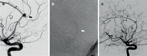 A Digital Subtraction Angiography Dsa Right Carotid Injection