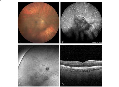 A Fundus Photograph Of The Right Eye Demonstrating Vitreous