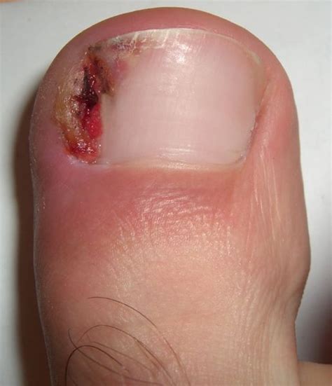 Infected Ingrown Toenail Abscess