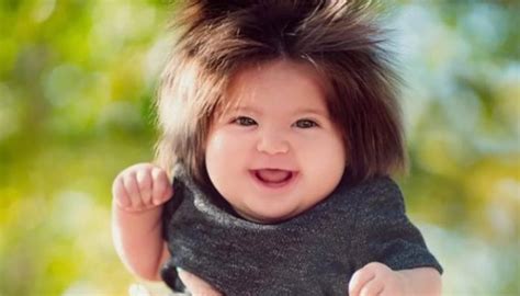 Des cheveux anormalement épais ont rendu cette enfant célèbre sur