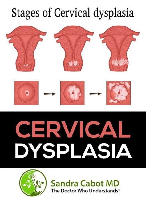 Cervical Dysplasia Artofit