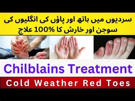 Sardi Mein Hath Or Pao Ki Sujan Ka Ilaj Chilblains Treatment YouTube