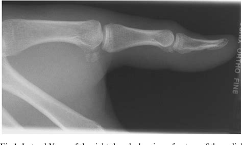 Figure 1 From Simultaneous Fractures Of The Ulnar And Radial Sesamoid Bones Of The Thumb