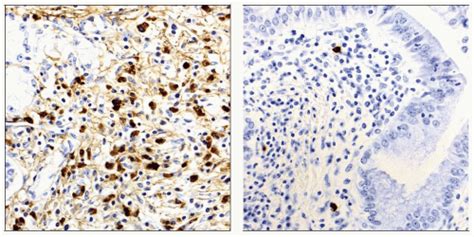 Ampullary Adenoma Basicmedical Key