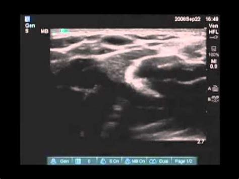 How To Peripheral Arm Veins For Vascular Access Scanning Technique